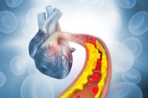 Illustration 3D d'un cœur humain avec une circulation sanguine obstruée sur fond bleu avec des plaquettes sanguines suggérées