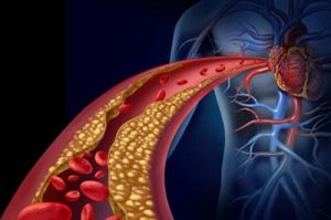 3-D Illustration eines menschlichen Herzens mit einer verstopften Blutbahn vor blauem Hintergrund