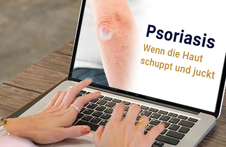 Frauenhände auf der Tastatur eines Laptops - auf dem Bildschirm ist eine Fachinformation zum Thema Psoriasis zu sehen