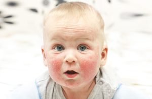 Gros plan sur le visage d'un bébé présentant des signes évidents de dermatite atopique