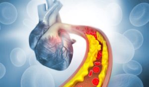 3-D Illustration vom menschlichen Herzen, im Vordergrund ist eine bereits verstopfte Arterie zu sehen, die zum Herzen führt