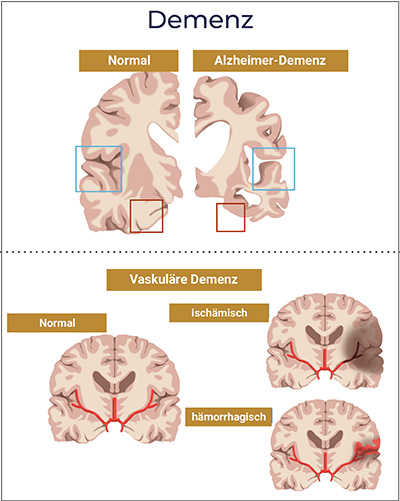 Illustration zur Alzheimer-Demenz und Vaskulärer Demenz