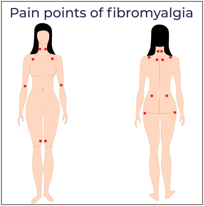 Fractal representation of the pain points in fibromyalgia